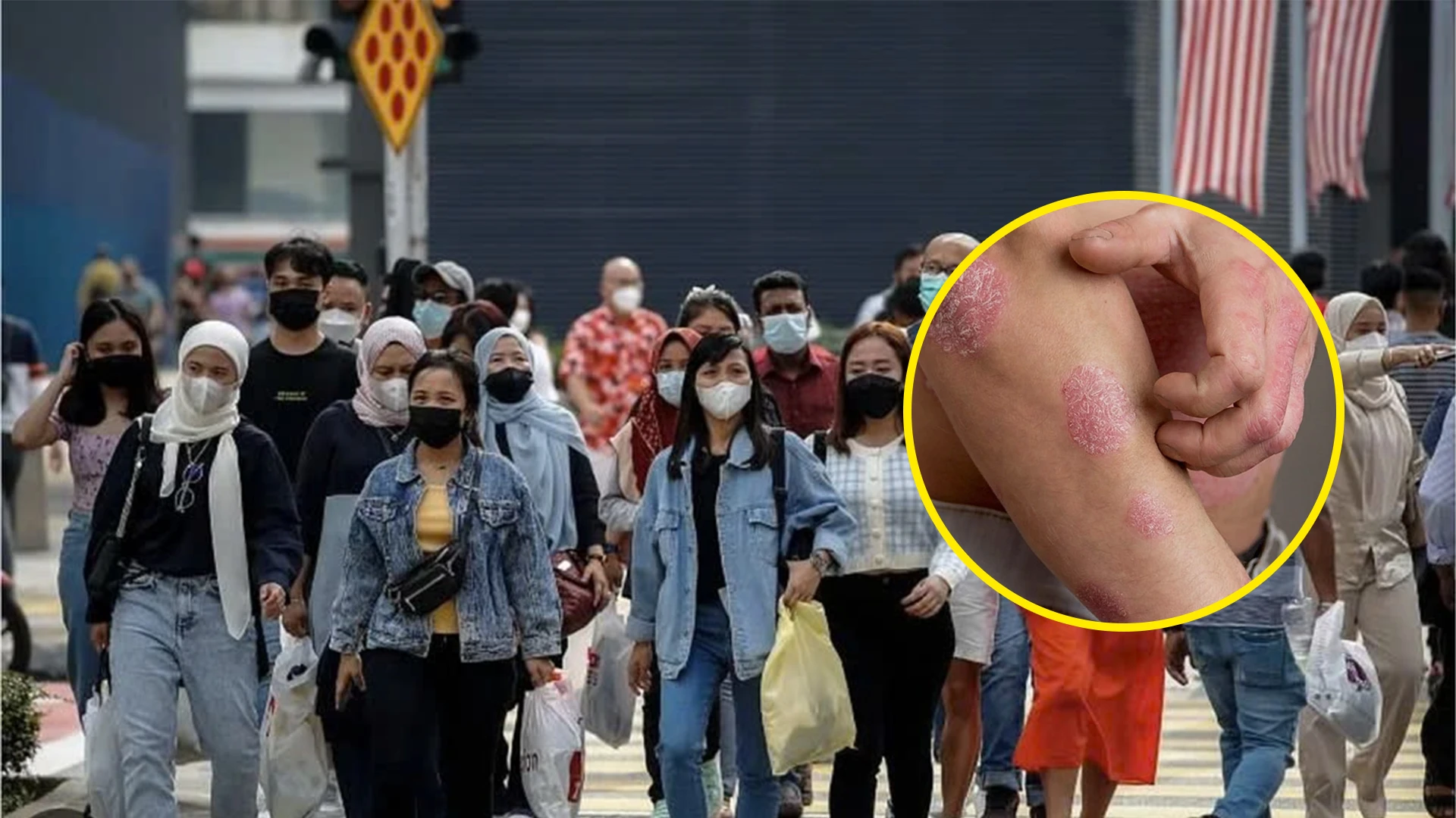 Sekitar lima juta orang Indonesia menderita penyakit psoriasis