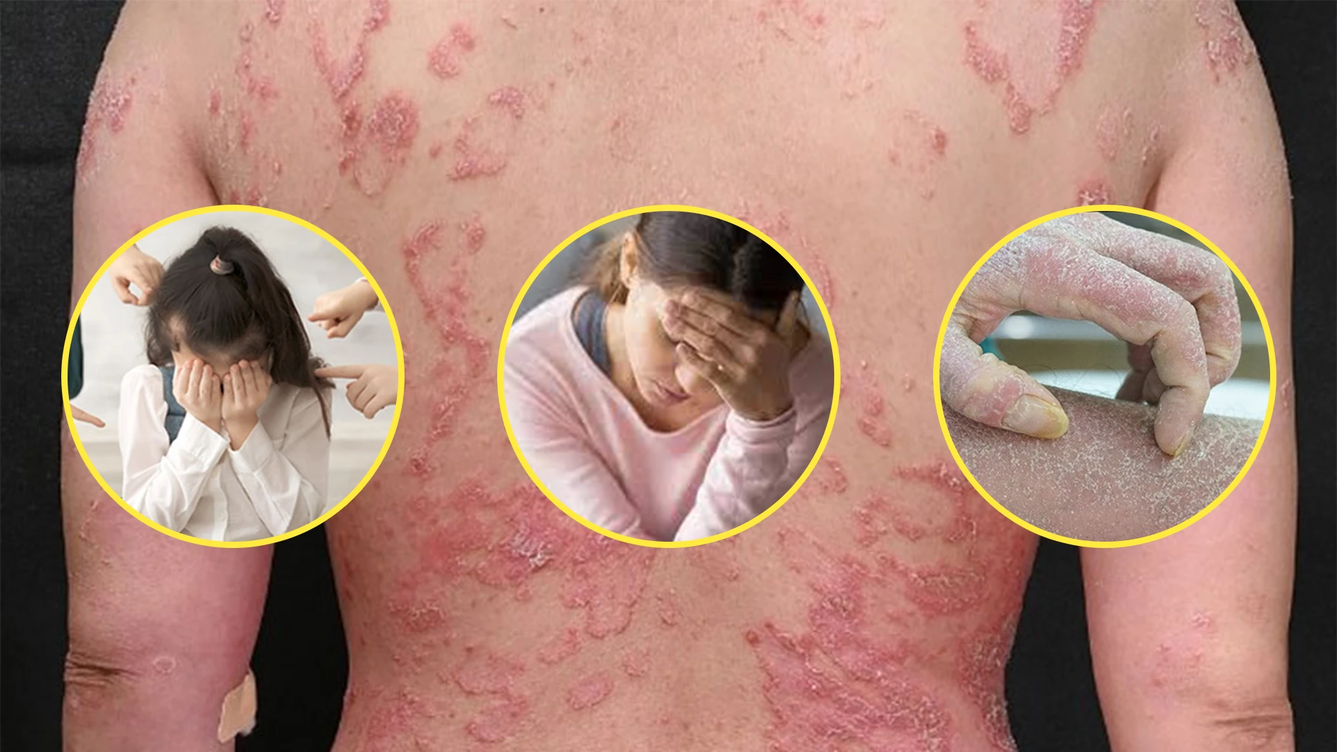 Psoriasis adalah penyakit yang menyebabkan rasa sakit fisik dan mental