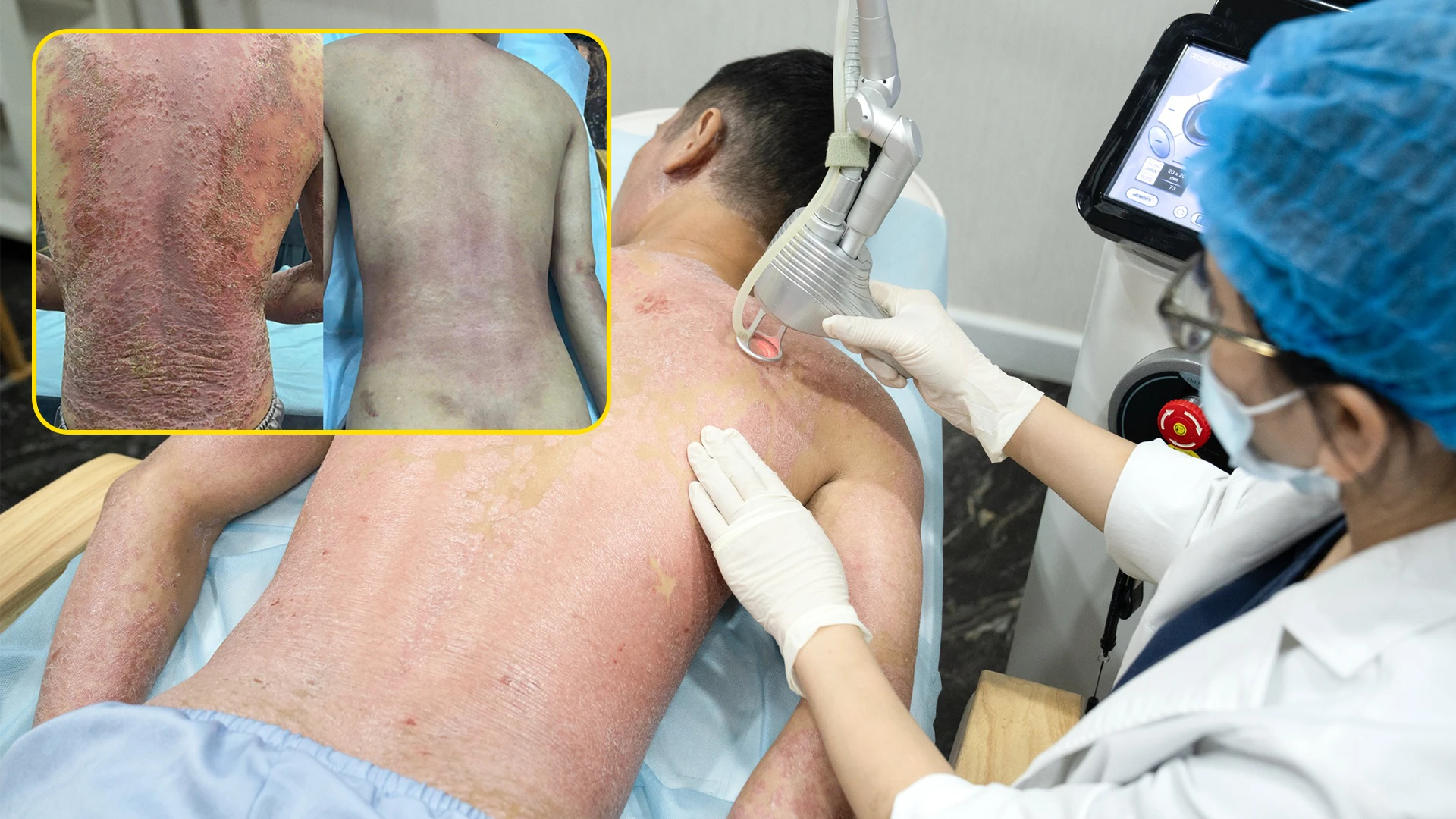Solusi baru untuk pasien psoriasis: Kisah sukses dengan teknologi Excimer Premium
